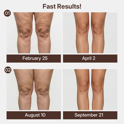 3D Compression Knee Sleeves –Say Goodbye to Saggy, Uneven-Looking Legs